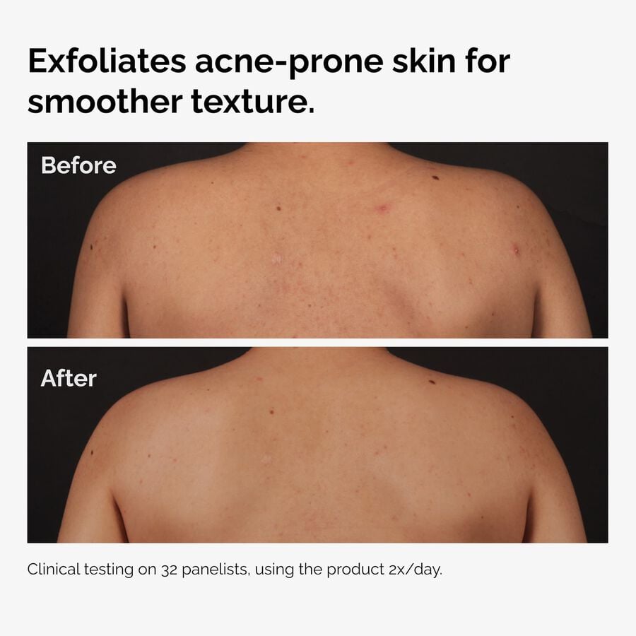 salicylic-acid-0-5-body-serum-s0 ord-salicylic-acid-body-serum-before-after-graphic-NA.jpg